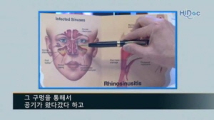 부비동염(축농증 예방)