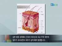 여드름 흉터 치료법
