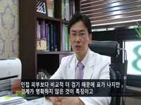 기미, 잡티의 치료방법