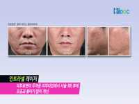 피부 미용을 위한 관리도 다양하게! 레이저 치료법