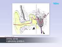 난청의 종류에 따른 원인과 증상, 그리고 치료법